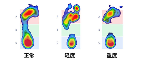 高弓足轻、重度